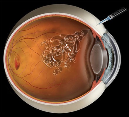 Sarı Nokta Hastalığı Nedir? Sarı Nokta Hastalığı Belirtileri